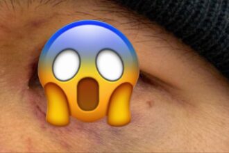 Asu Almabayev Reveals Graphic Eye Injury Days After Controversial Loss Against Manel Kape