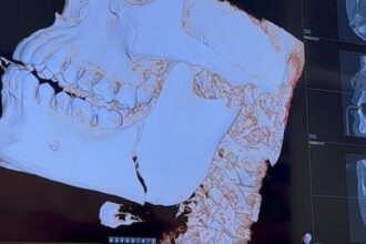 Nikolas Motta shows off fractured jaw X-rays after memorable UFC clash: ‘F*ck that one hurt’