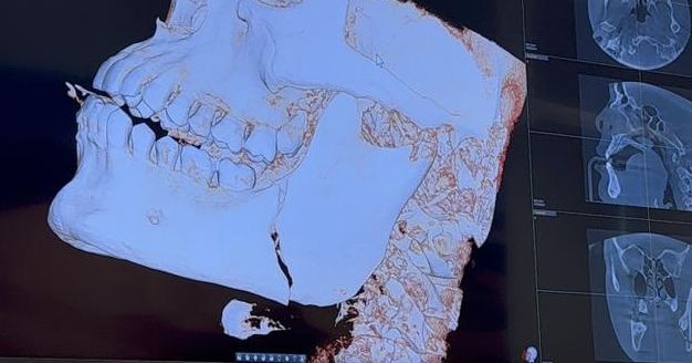 Nikolas Motta shows off fractured jaw X-rays after memorable UFC clash: ‘F*ck that one hurt’